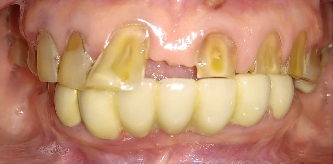 Crowns and full mouth rehabilitation: before treatment