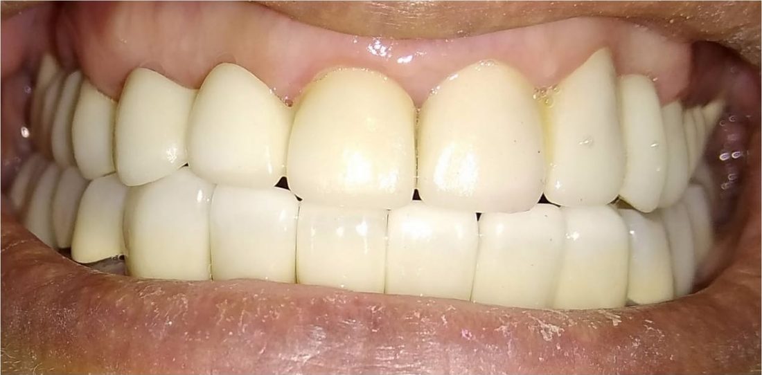 Dental Crowns and Caps in Rohtak: a case treated at Dr. Sapna's Dental Care