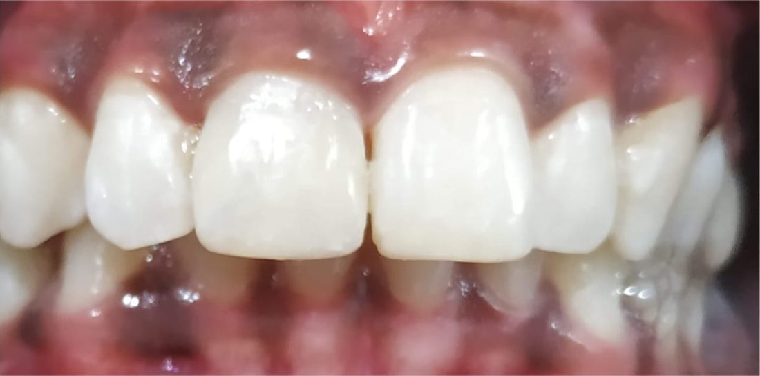 Smile Makeover and Designing at Dr. Sapna's Dental Care, Rohtak